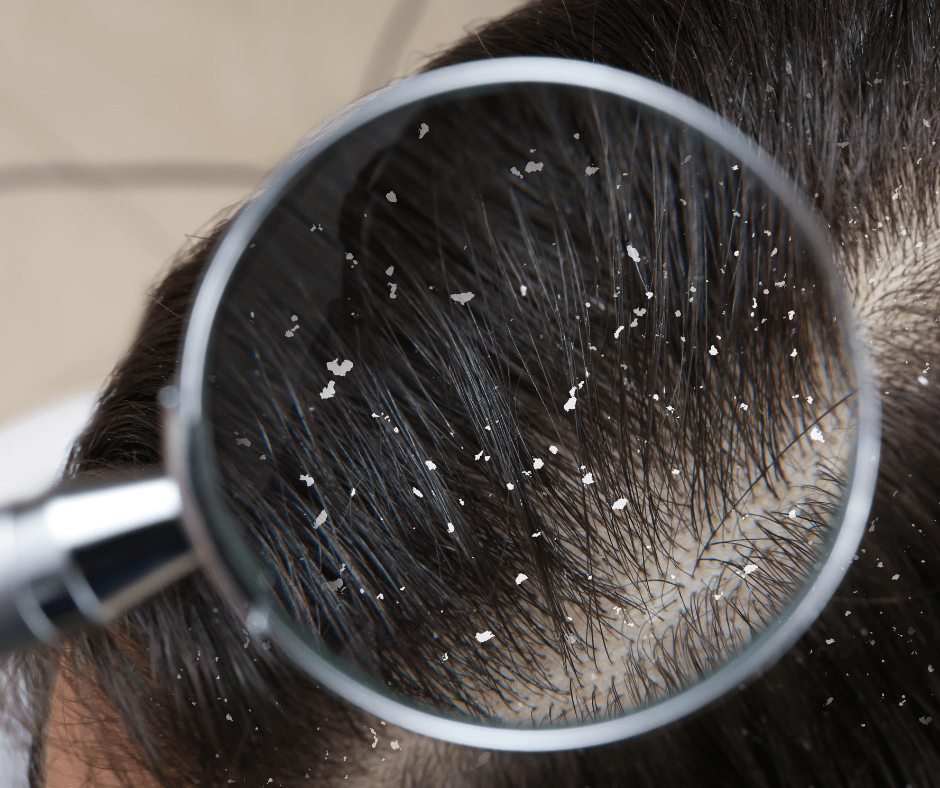 Dandruff Relief advice by master barber in edmonton and sherwood park.